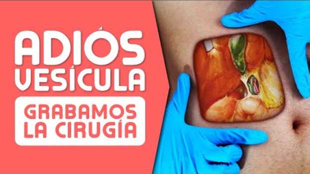 Видео LA VESÍCULA ¿Cuándo es Mejor OPERAR? Síntomas, Cálculos, Pólipos y Cáncer на русском