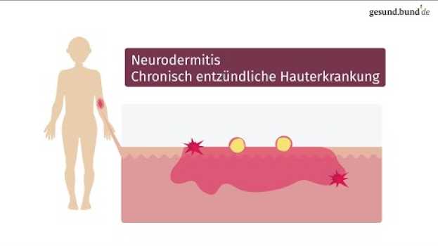 Video Was ist Neurodermitis und wie kann man sie behandeln? en français