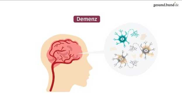 Video Was ist eine Demenz? en français